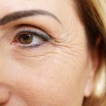 Dark Eye Circles – Do Genetics Matter?