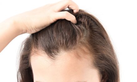 Hairloss and how to prevent it
